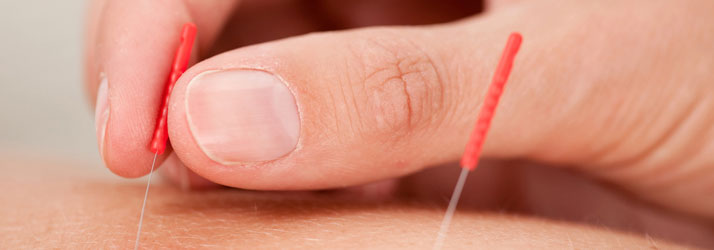 Neuropathy Newhall IA Trigger Point Dry Needling Therapy